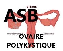 Ovaires polykystiques: symptômes  cause ,traitement naturel