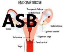 Heal endometriosis with natural plant