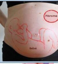 Fibrome myome grossesse