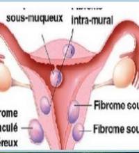 Fibrome myome types