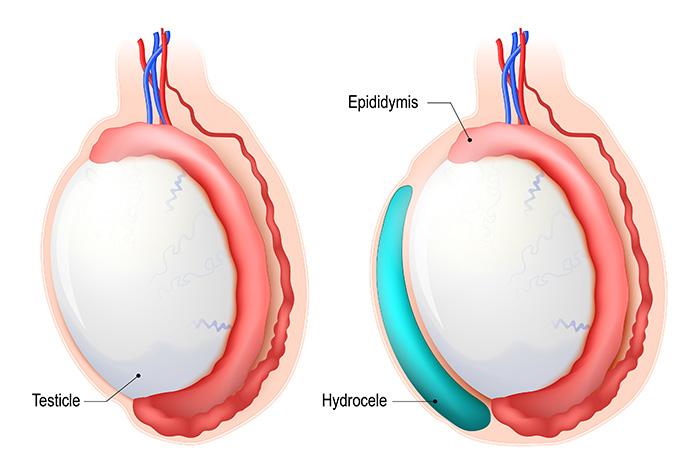 Atrophie Testiculaire Traitement Naturel