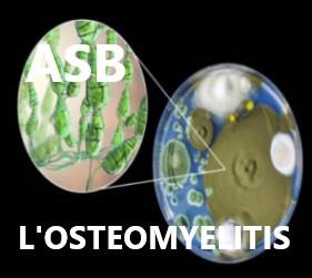 Se débarrasser naturellement de l'ostéomyélite