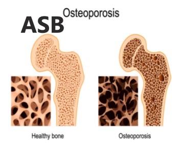 Osteoporosis