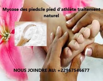 Mycose des pieds:le pied d'athlète traitement naturel