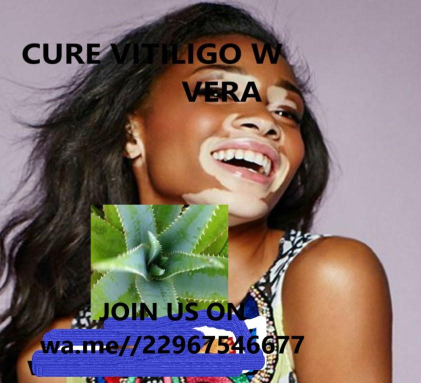 Aloe Vera virtues on Vitiligo