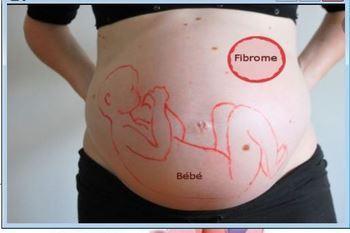 Fibrome myome grossesse