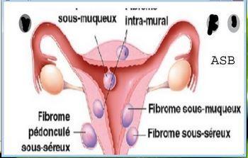 Fibrome myome types